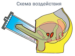 Клиникам НЕО-МЕД. Физиотерапия в урологии